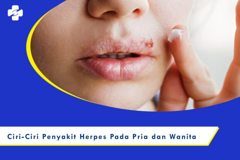 Jarang Disadari Ini Ciri Ciri Penyakit Herpes Klinik Utama Sentosa