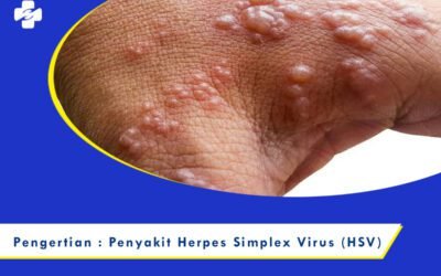Pengertian : Penyakit Herpes Simplex Virus (HSV)
