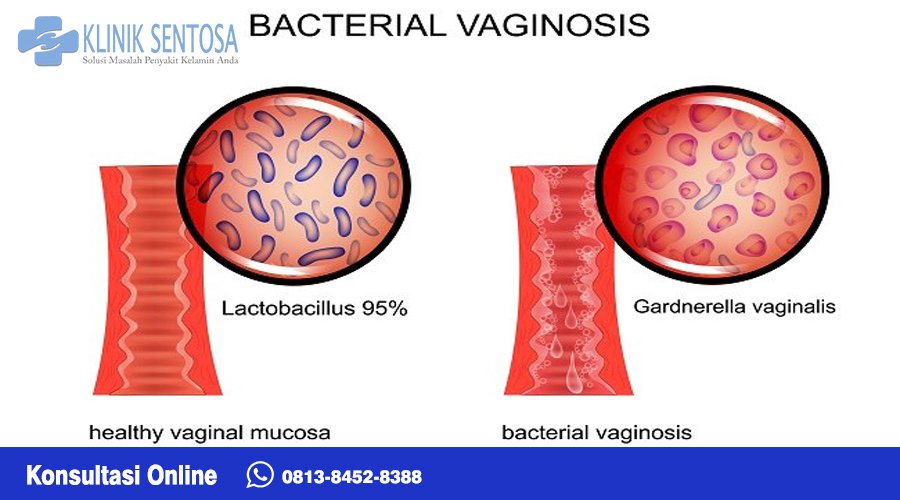 vulvovaganitis dapat menyebabkan keputihan dengan bau yang tidak sedap, rasa terbakar atau perih pada vagina, serta pembengkakan dan kemerahan pada vagina, vulva, dan perineum (area antara vagina dan anus).