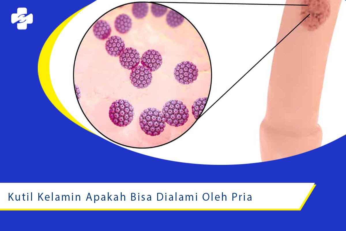 Kutil Kelamin Apakah Bisa Dialami Oleh Pria