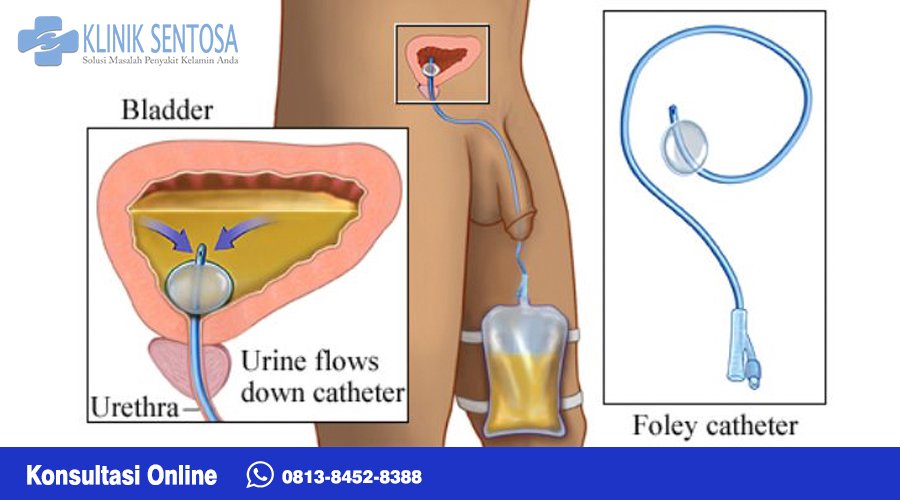 Mereka dapat memasukkan melalui tabung yang mengeluarkan urin dari kandung kemih (kateter uretra) atau melalui lubang kecil yang dibuat di perut bagian bawah (kateter suprapubik).