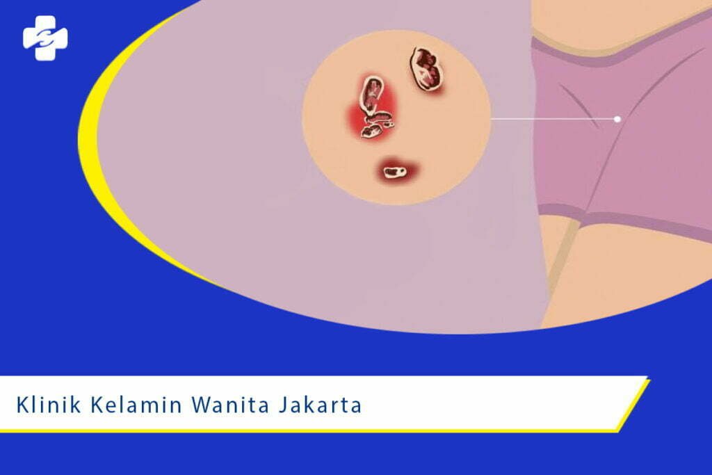 Klinik Penyakit Kelamin Wanita Jakarta Utara