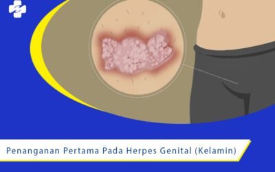 Penanganan Pertama pada Herpes Genital (Kelamin)