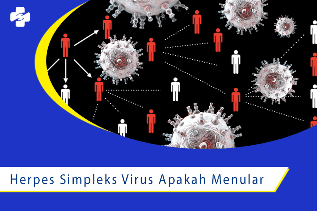 Cara Penularan Herpes Simpleks Virus