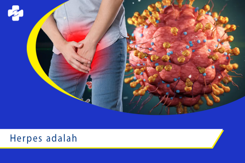 Pengertian Penyakit Menular Herpes Klinik Utama Apollo