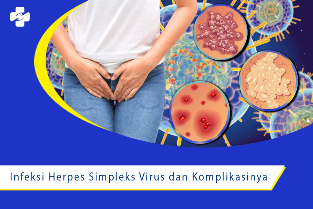 Wapadai Komplikasi dari Herpes Simplex Virus  