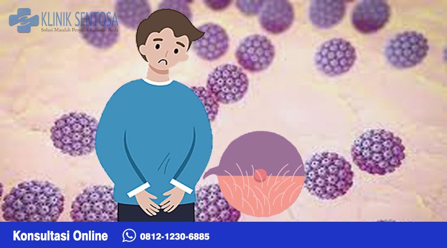 Kutil kelamin ringan sendiri merupakan gejala kecil dari penyakit ini seperti benjolan halus berwarna merah muda yang muncul sekitar alat vital atau di dalam.