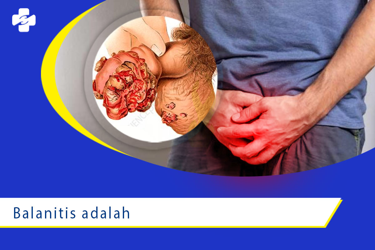 Radang Kepala Penis (Balanitis): Gejala, Penyebab dan Pengobatannya