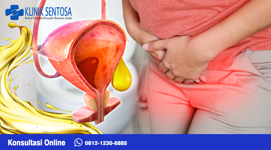 Uretritis adalah masalah yang dimana uretra mengalami radang dan juga iritasi. Uretra sendiri merupakan bagian yang membawa urin dari kandung kemih ke luar kemih saat ingin buang urin.