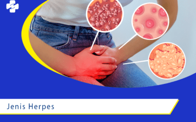 Pelajari Jenis Herpes dan Dampak Risiko