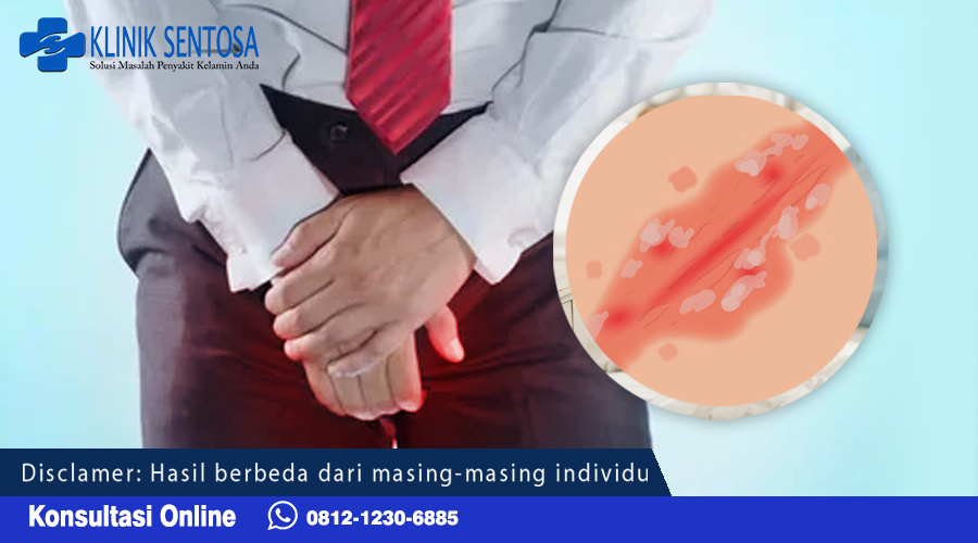Selain itu, dokter juga dapat meresepkan obat pereda nyeri untuk mengurangi rasa sakit pada testis yang terinfeksi. 