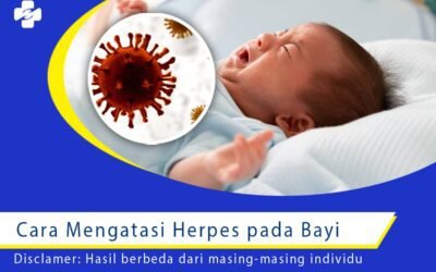 Cara Mengatasi Herpes pada Bayi