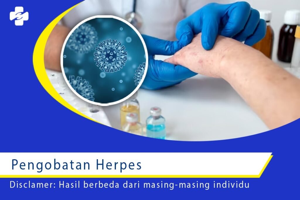 Deretan Pengobatan Penyakit Herpes