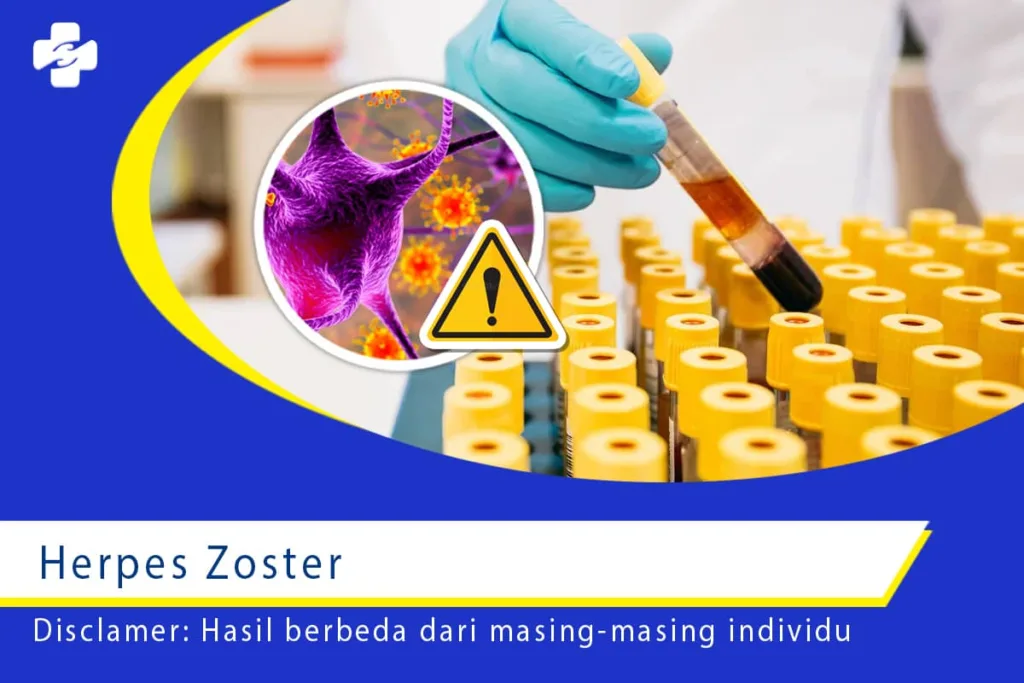 Herpes Zoster 1