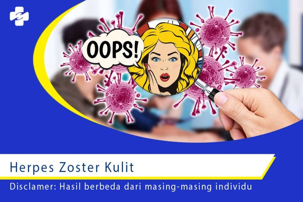 Herpes Zoster Kulit 1