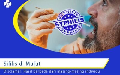 Sifilis di Mulut 1
