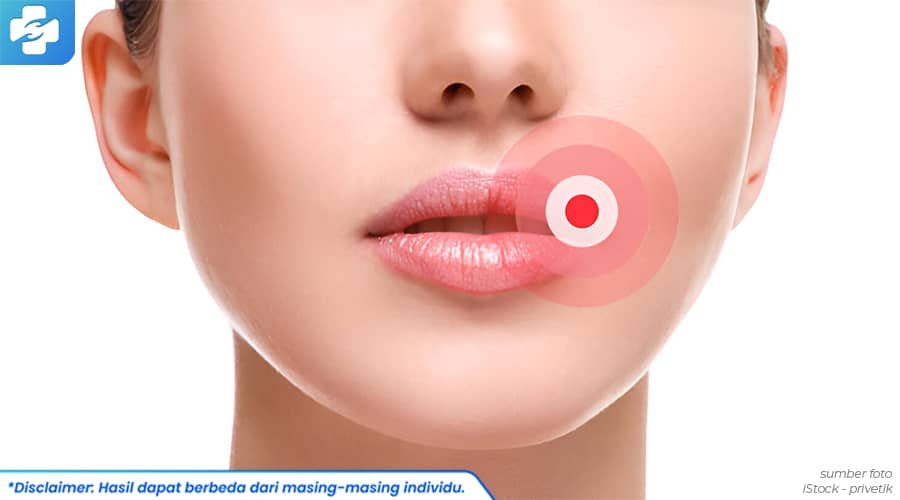 herpes di bibir 1