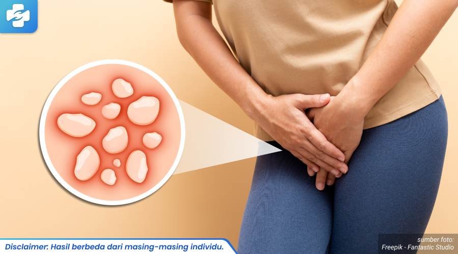 tanda herpes kelamin parah 1_1_11zon