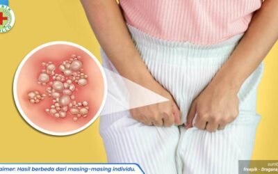 kutil kelamin gatal meradang 1_1_11zon