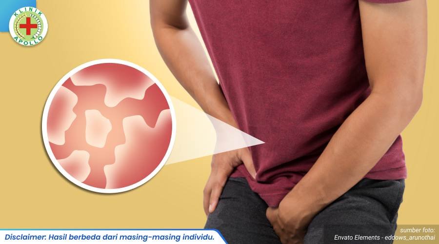 selangkangan gatal berjamur 2_3_11zon