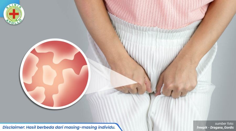 selangkangan berjamur 1_5_11zon