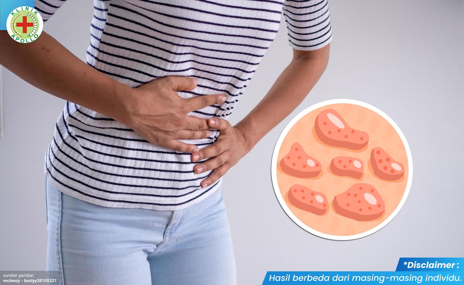 cara menghilangkan kutil kelamin 2_1_11zon