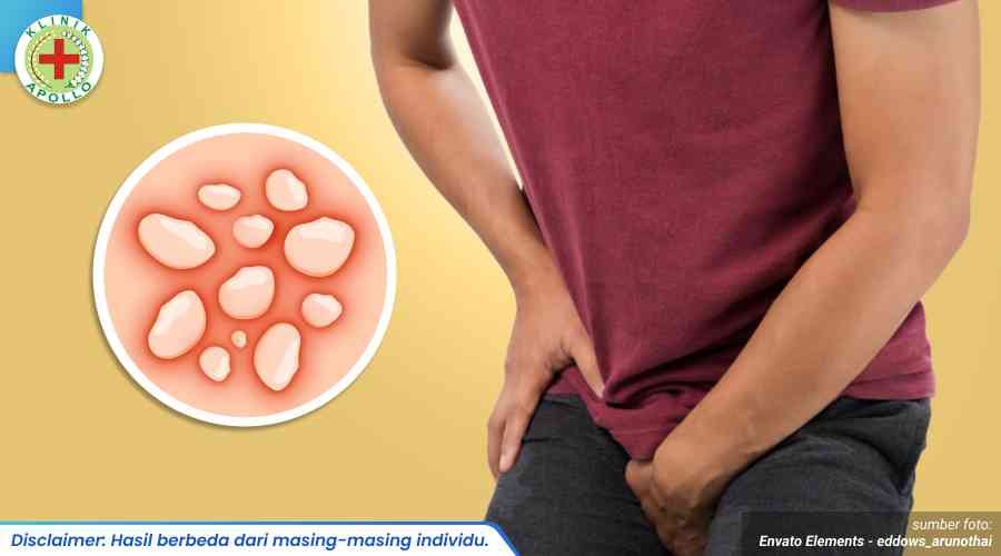 gejala herpes kulit kelamin 1_3_11zon